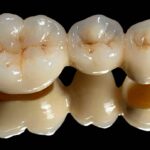 Цирконієві коронки: відгуки пацієнтів 2026 — чи варто ставити і кому не підходять?